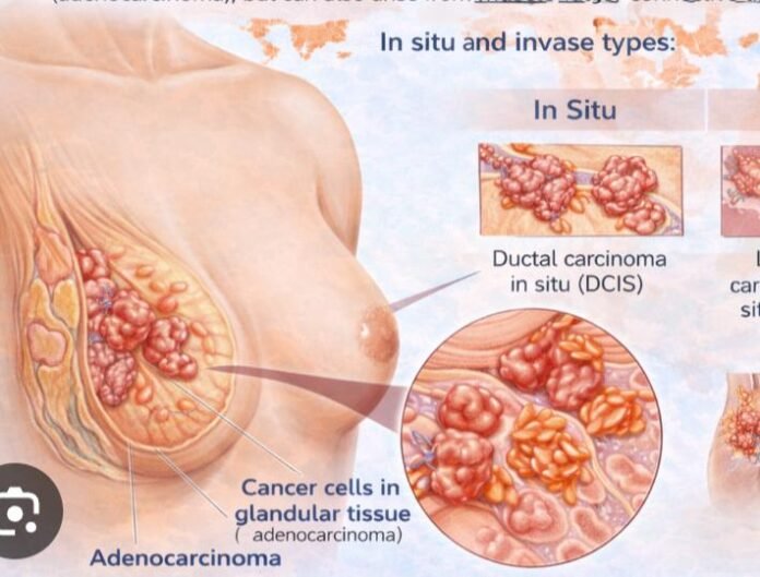 उत्तराखंड में स्तन कैंसर जांच को नई रफ्तार, आधुनिक तकनीक से पौड़ी-टिहरी में हफ्ते में दो बार स्क्रीनिंग शिविर शुरू